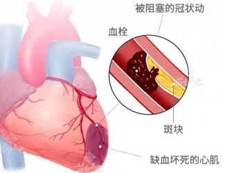 心脏病该怎么办，且看临床治疗医案一则